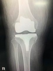 変形性膝関節症(TKA)症例(術後X線)