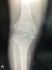 変形性膝関節症(TKA)症例(術前X線)