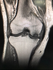 特発性大腿骨内顆骨壊死(UKA)症例(術前MRI)