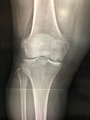 特発性大腿骨内顆骨壊死(UKA)症例(術前X線)